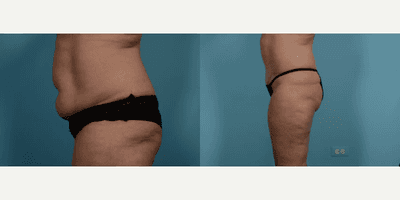 Case 1434 - Woman treated with Tummy Tuck