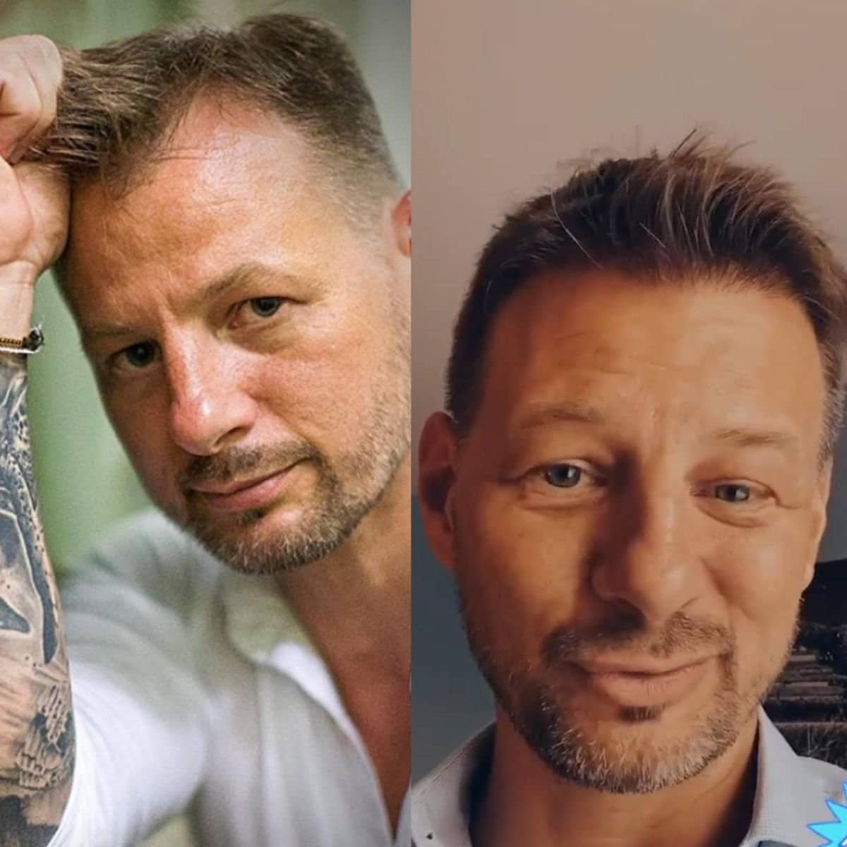 Case 14347 - DHI hair transplant