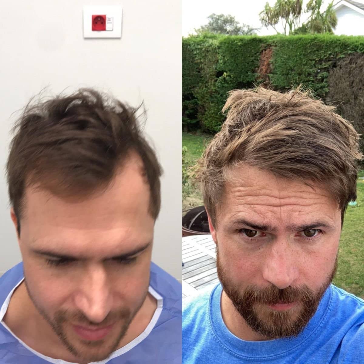 Case 14348 - DHI hair transplant