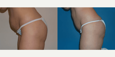 Case 1435 - Woman treated with Tummy Tuck