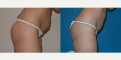 Case 1436 - Woman treated with Tummy Tuck