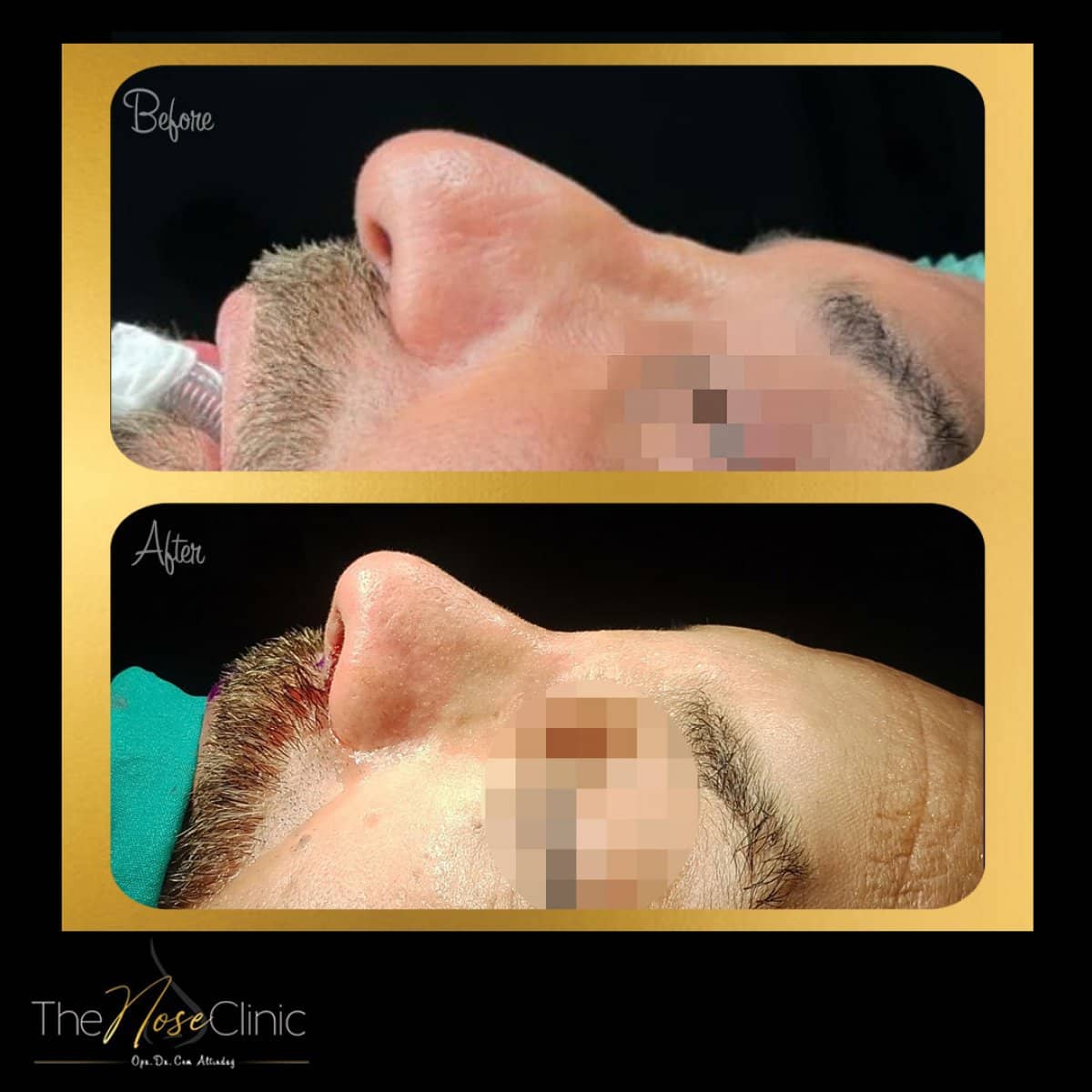 Case 14368 - rhinoplasty