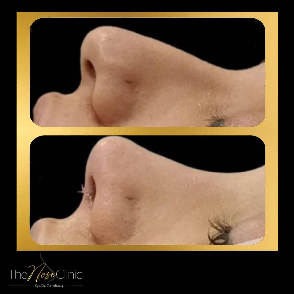Case 14369 - rhinoplasty