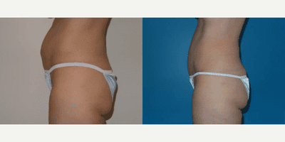 Case 1437 - Woman treated with Tummy Tuck