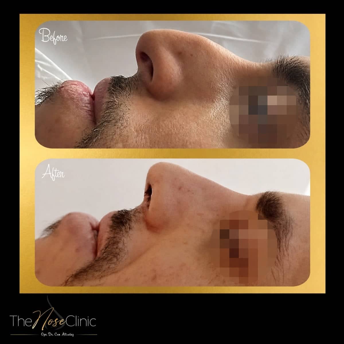 Case 14370 - septoplasty