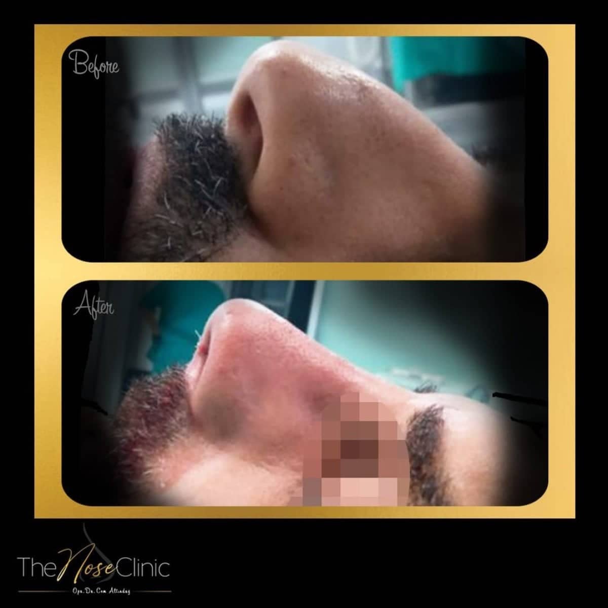 Case 14372 - revision rhinoplasty