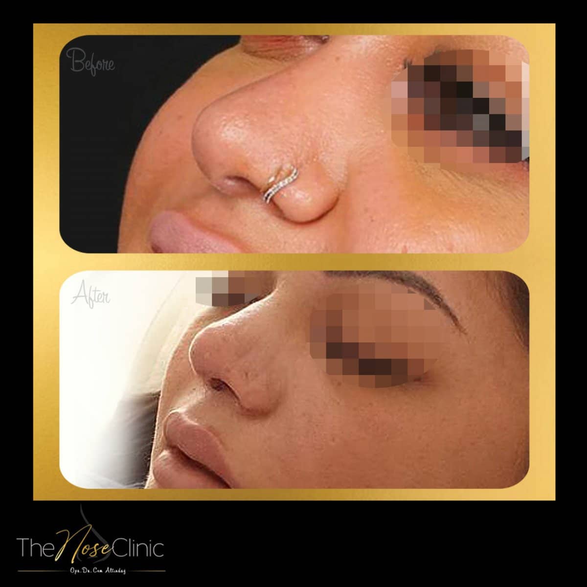 Case 14373 - rhinoplasty