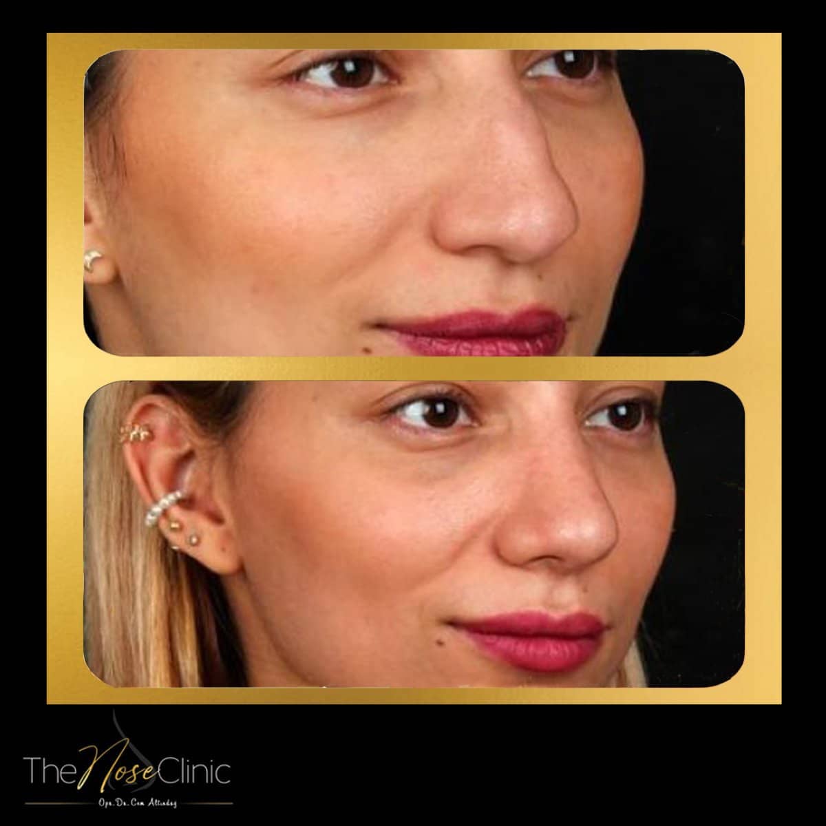 Case 14375 - rhinoplasty