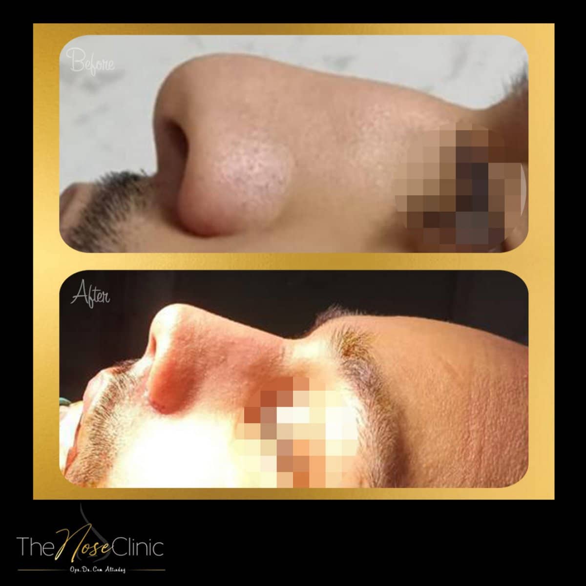 Case 14376 - rhinoplasty