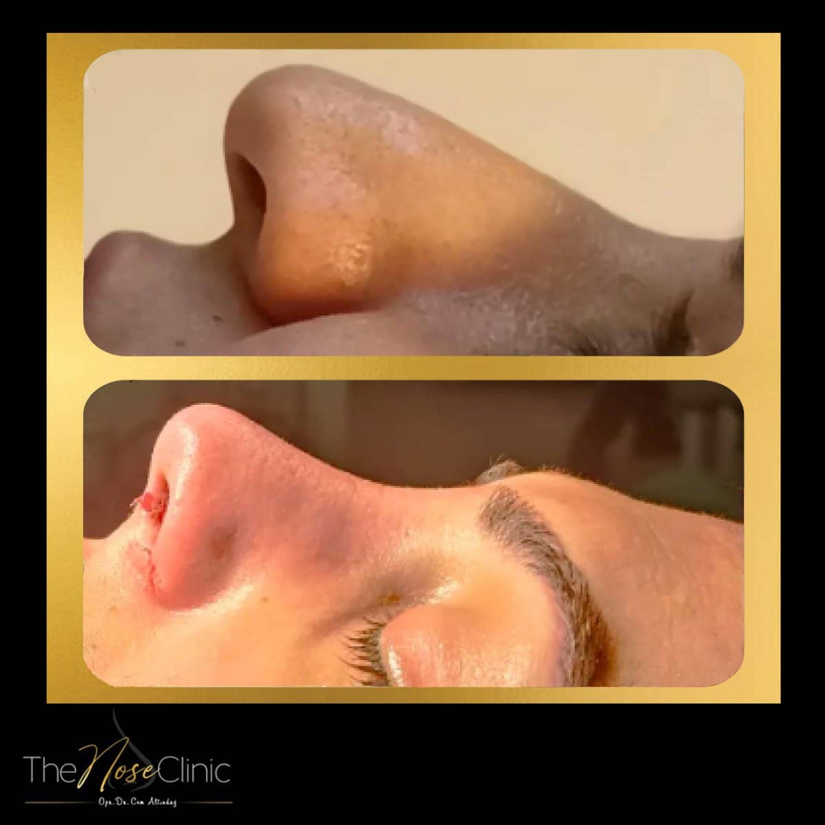 Case 14377 - tip rhinoplasty