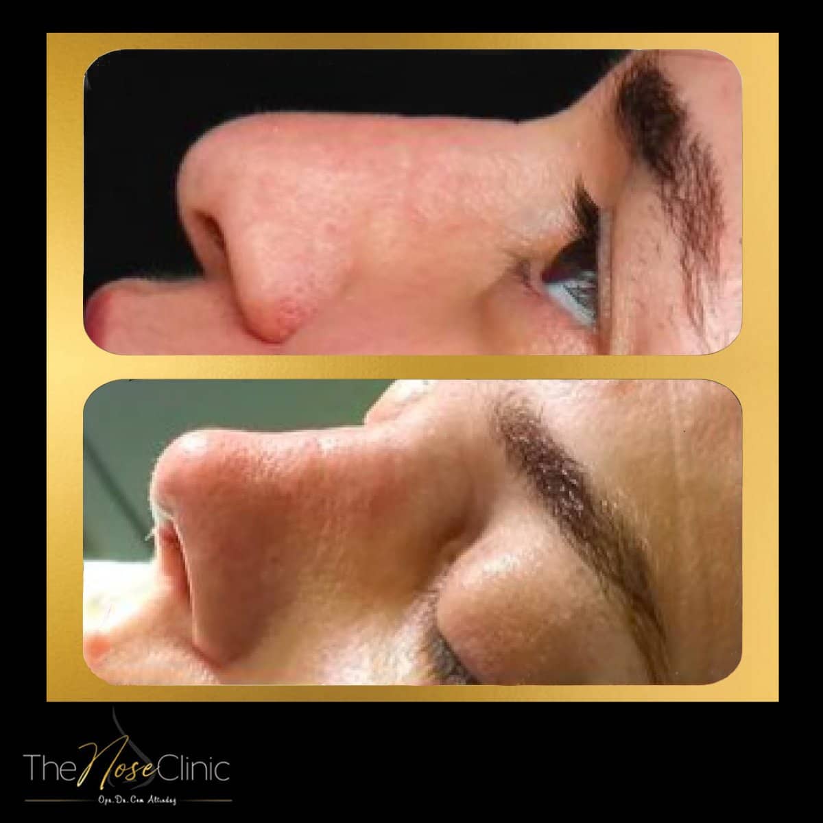 Case 14379 - tip rhinoplasty