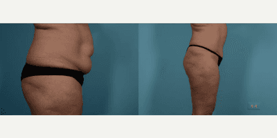 Case 1438 - Woman treated with Tummy Tuck