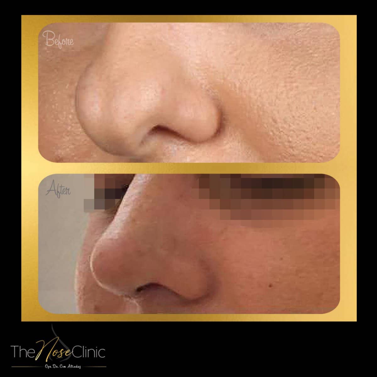 Case 14380 - rhinoplasty