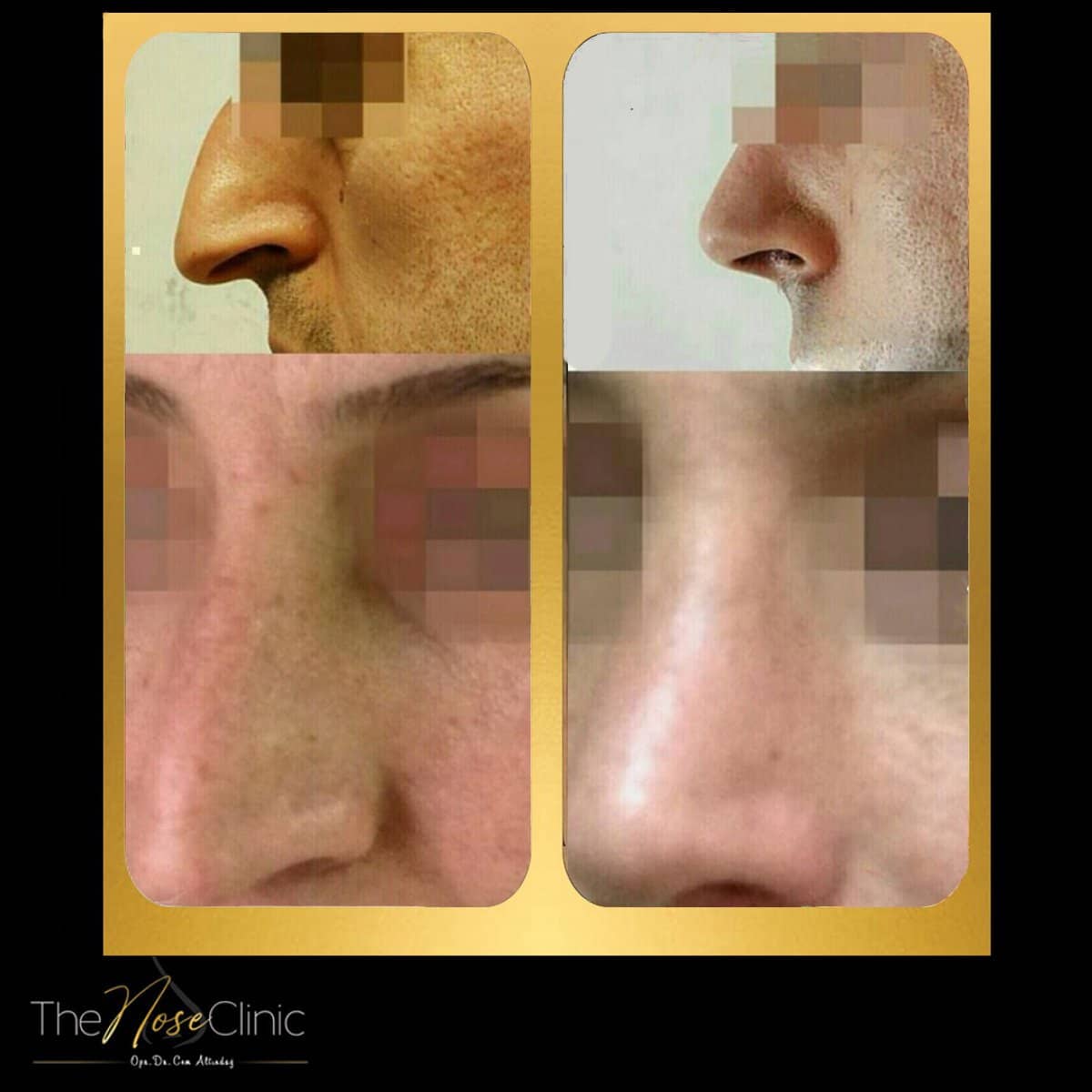 Case 14381 - rhinoplasty