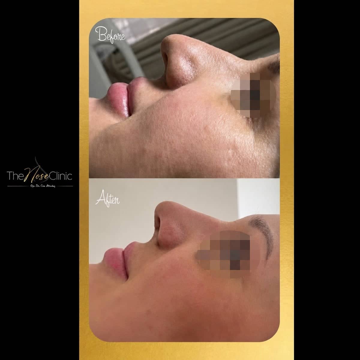 Case 14382 - rhinoplasty