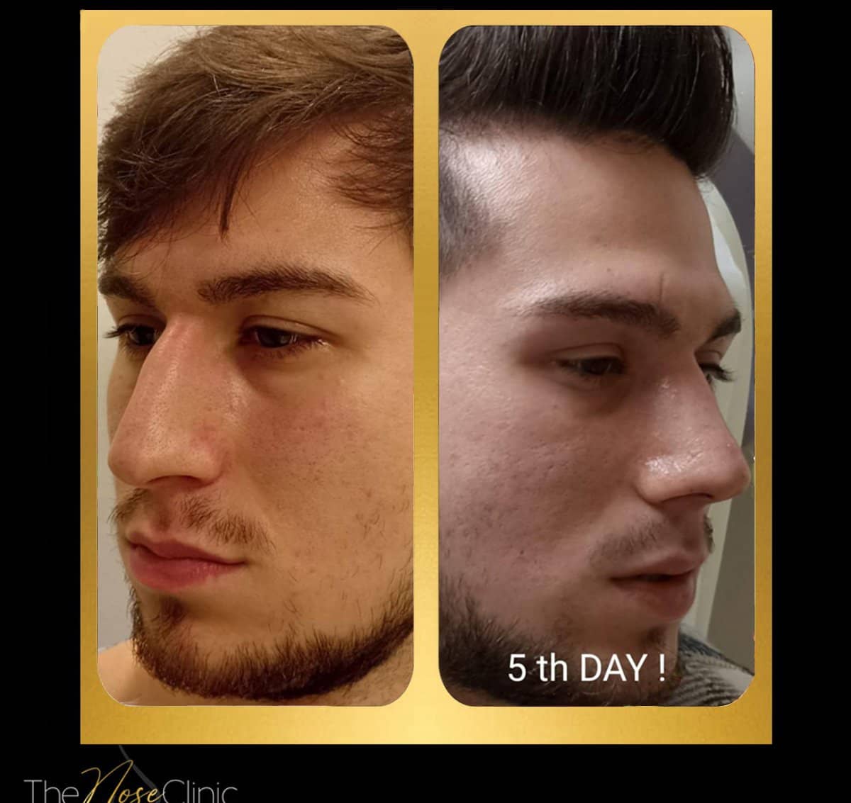 Case 14383 - rhinoplasty