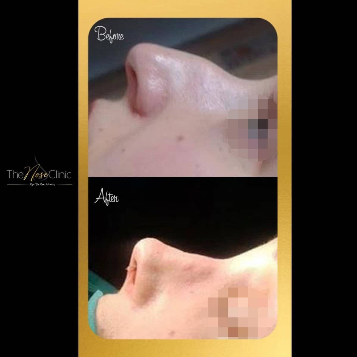 Case 14384 - septoplasty