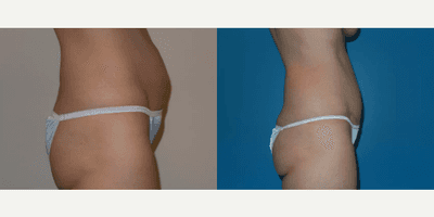 Case 1439 - Woman treated with Tummy Tuck