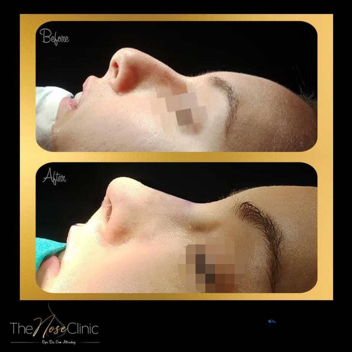 Case 14390 - rhinoplasty