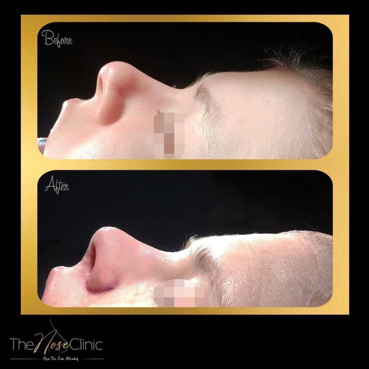 Case 14392 - rhinoplasty