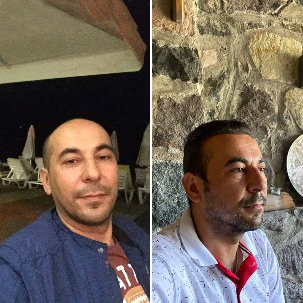 Case 14438 - organic hair transplant