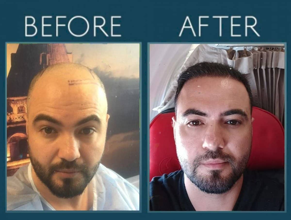 Case 14439 - DHI hair transplant