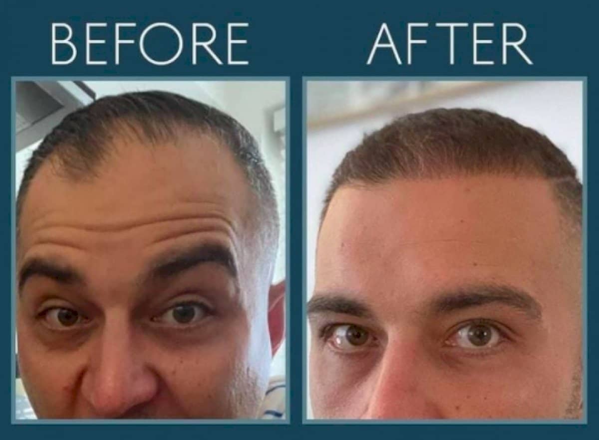 Case 14440 - FUE hair transplant