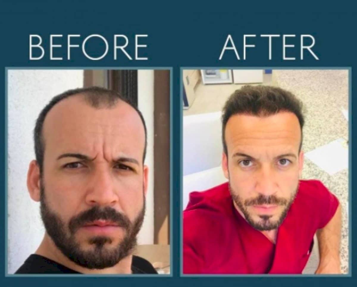 Case 14442 - FUE hair transplant