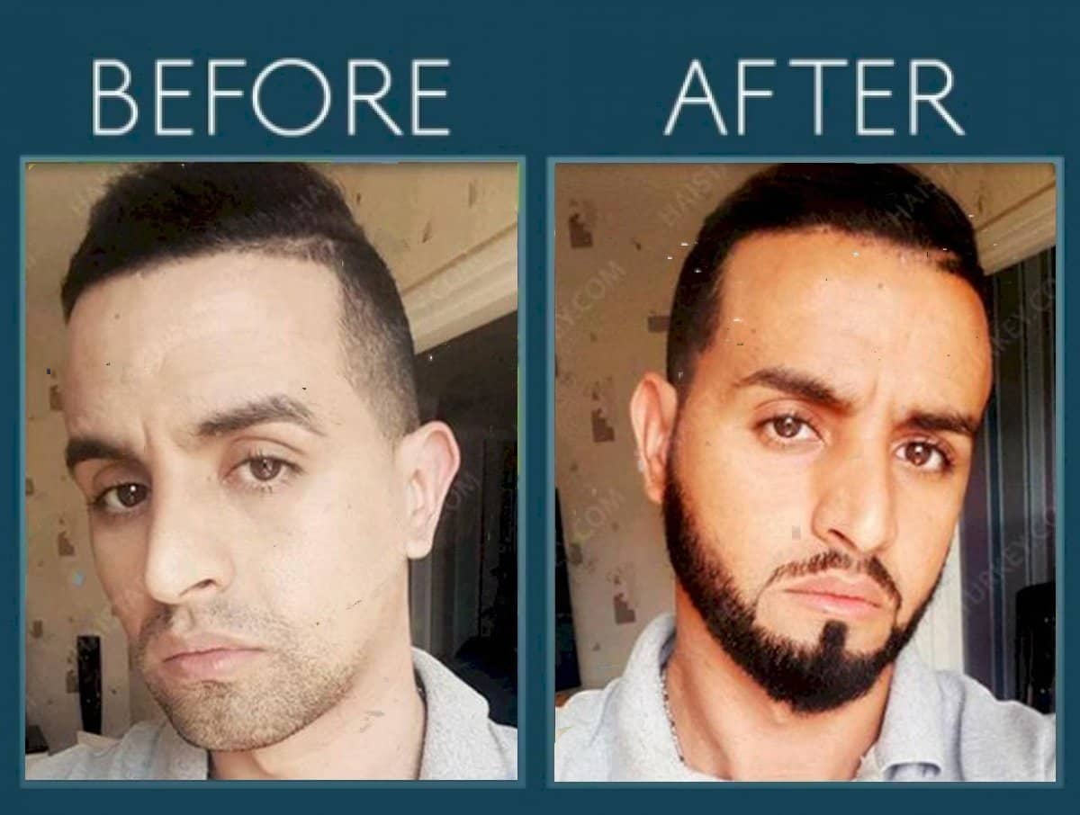 Case 14443 - beard transplant