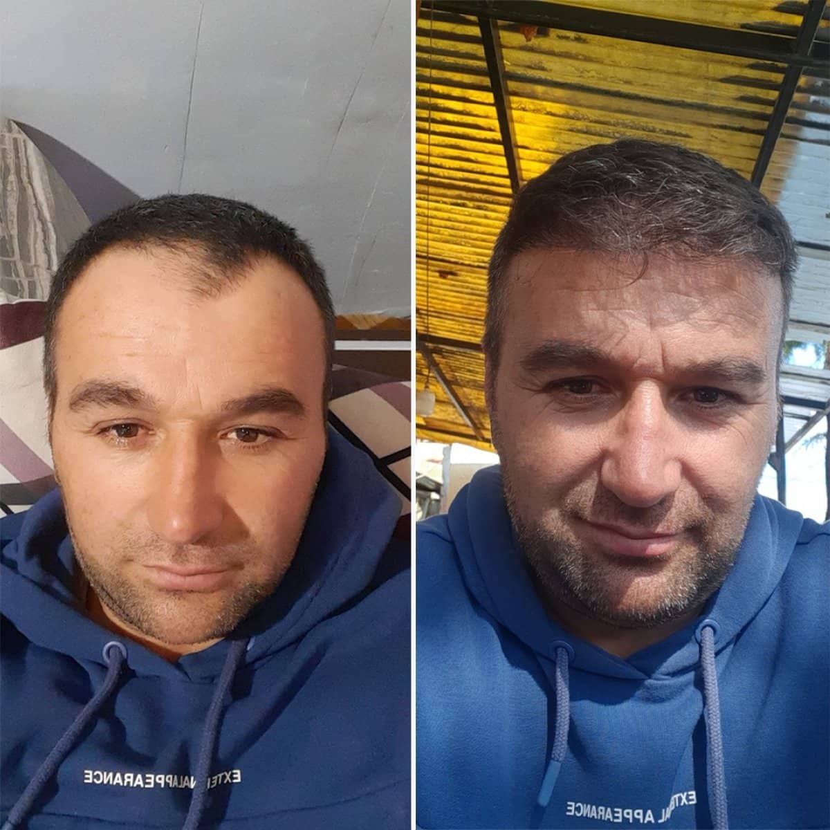 Case 14445 - organic hair transplant