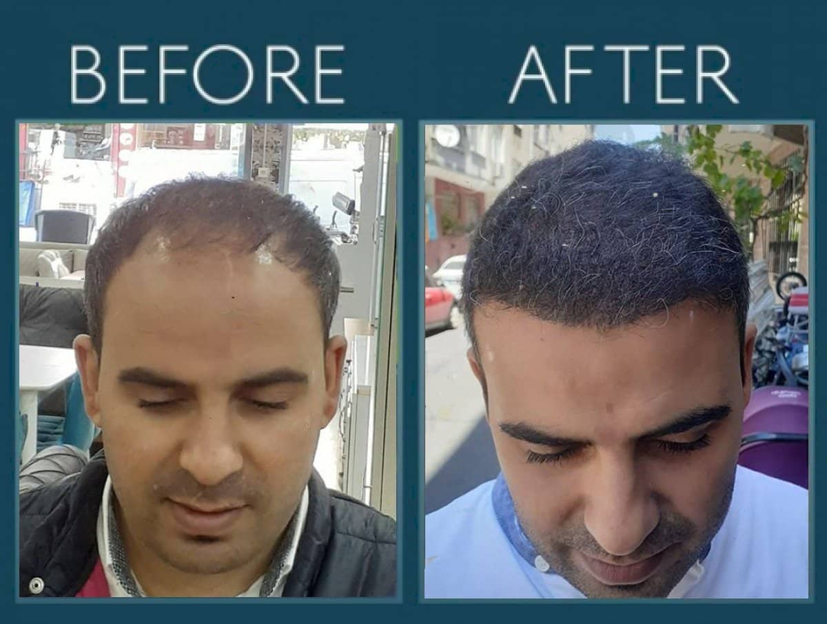 Case 14446 - DHI hair transplant