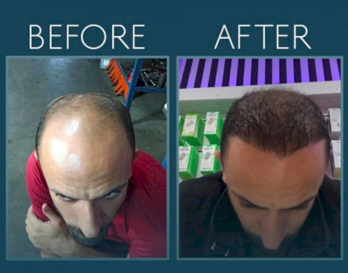 Case 14447 - hair transplant