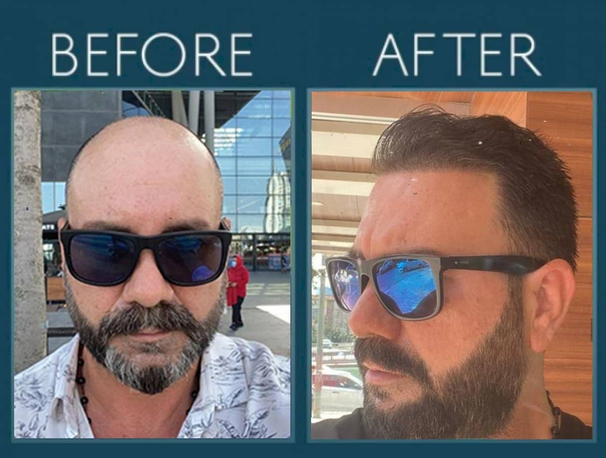 Case 14448 - DHI hair transplant