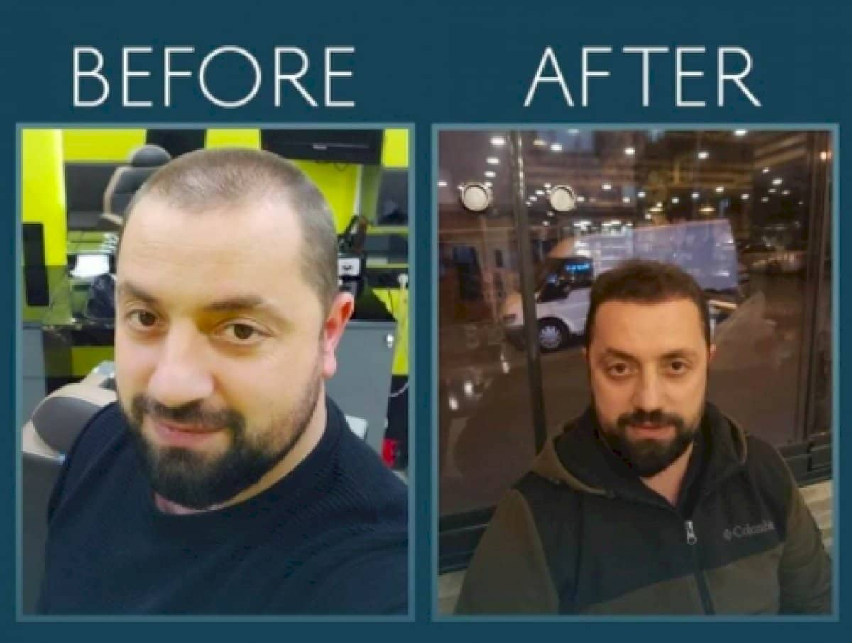 Case 14450 - DHI hair transplant