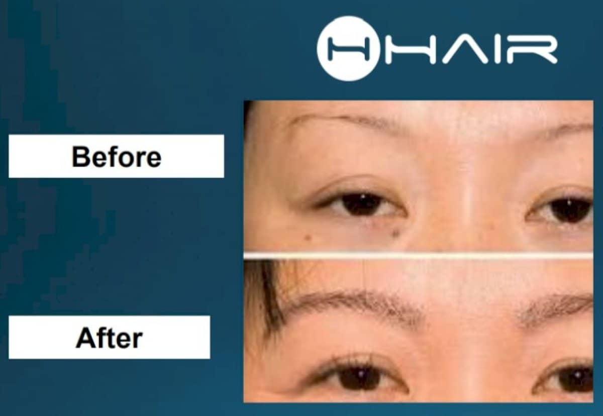 Case 14451 - eyebrow transplant