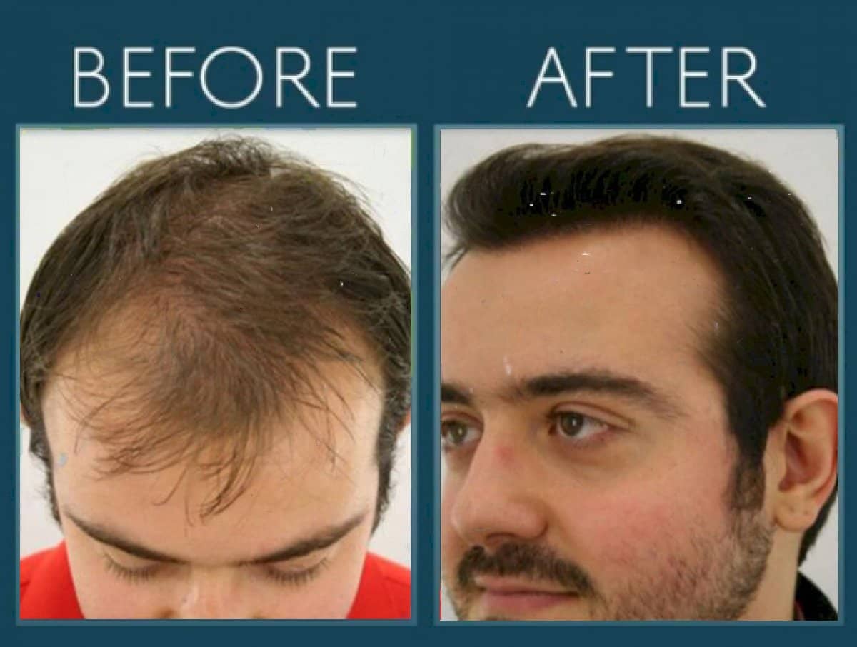Case 14452 - FUE hair transplant