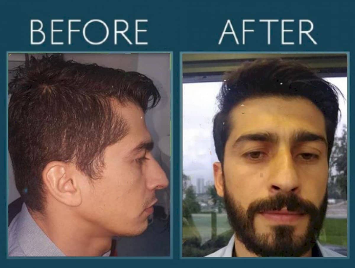 Case 14453 - beard transplant