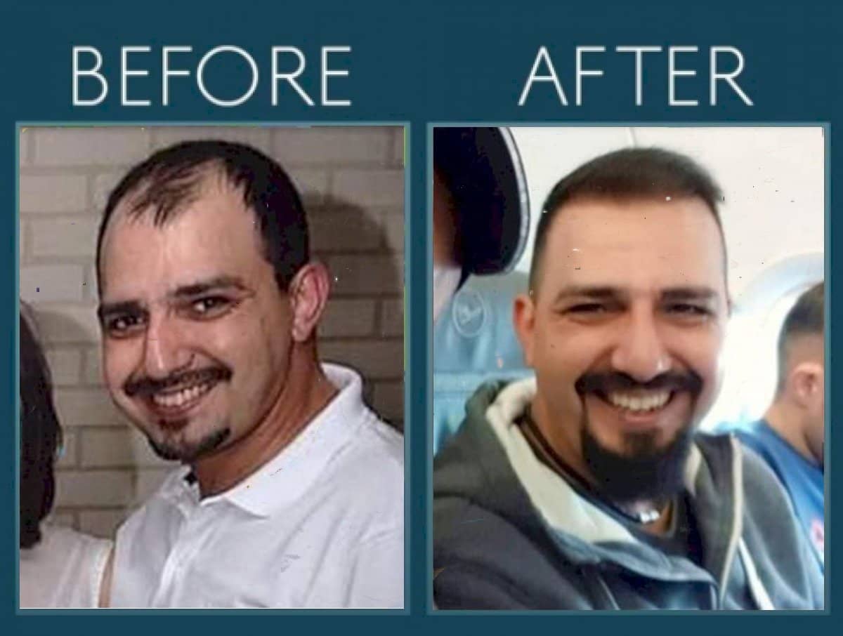 Case 14455 - FUE hair transplant
