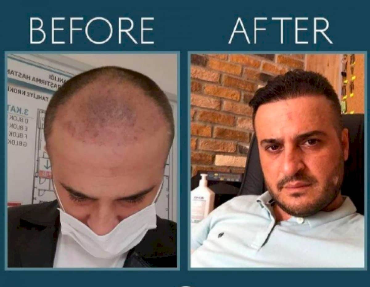 Case 14456 - FUE hair transplant