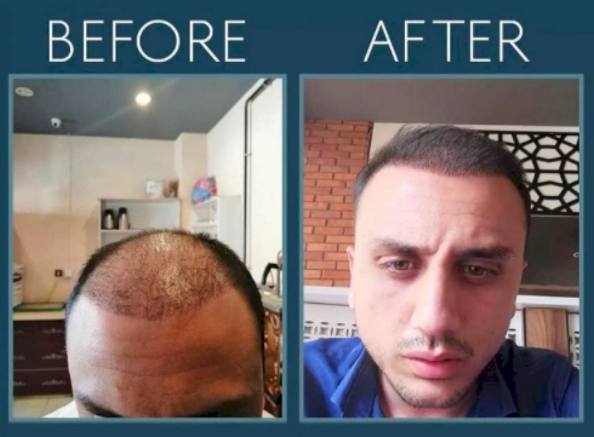 Case 14457 - hair transplant