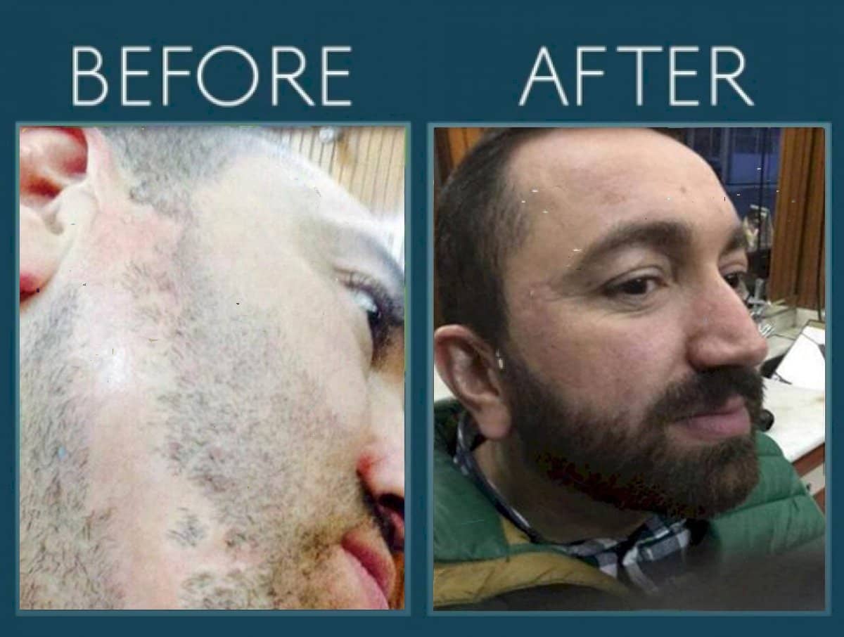 Case 14458 - beard transplant