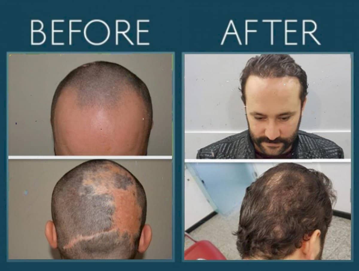 Case 14459 - FUE hair transplant