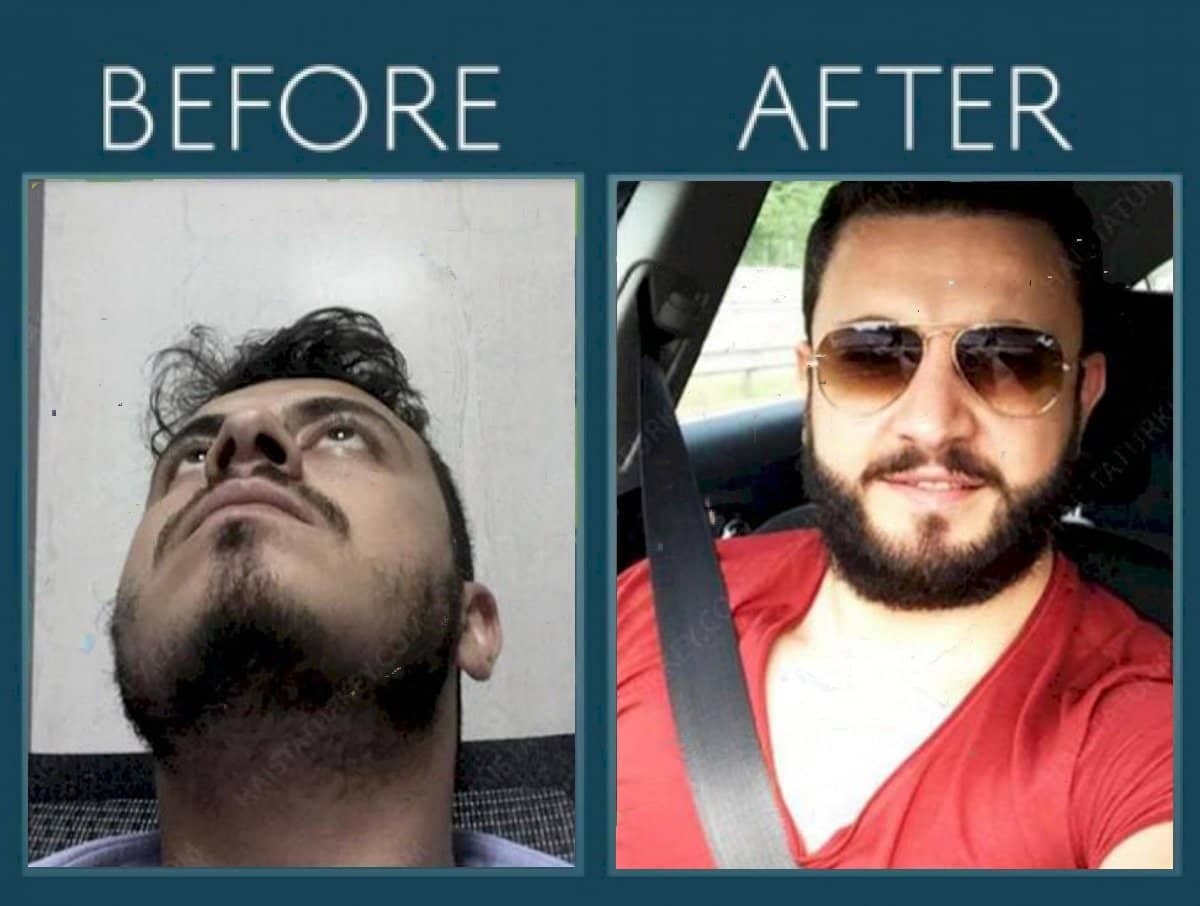 Case 14464 - beard transplant