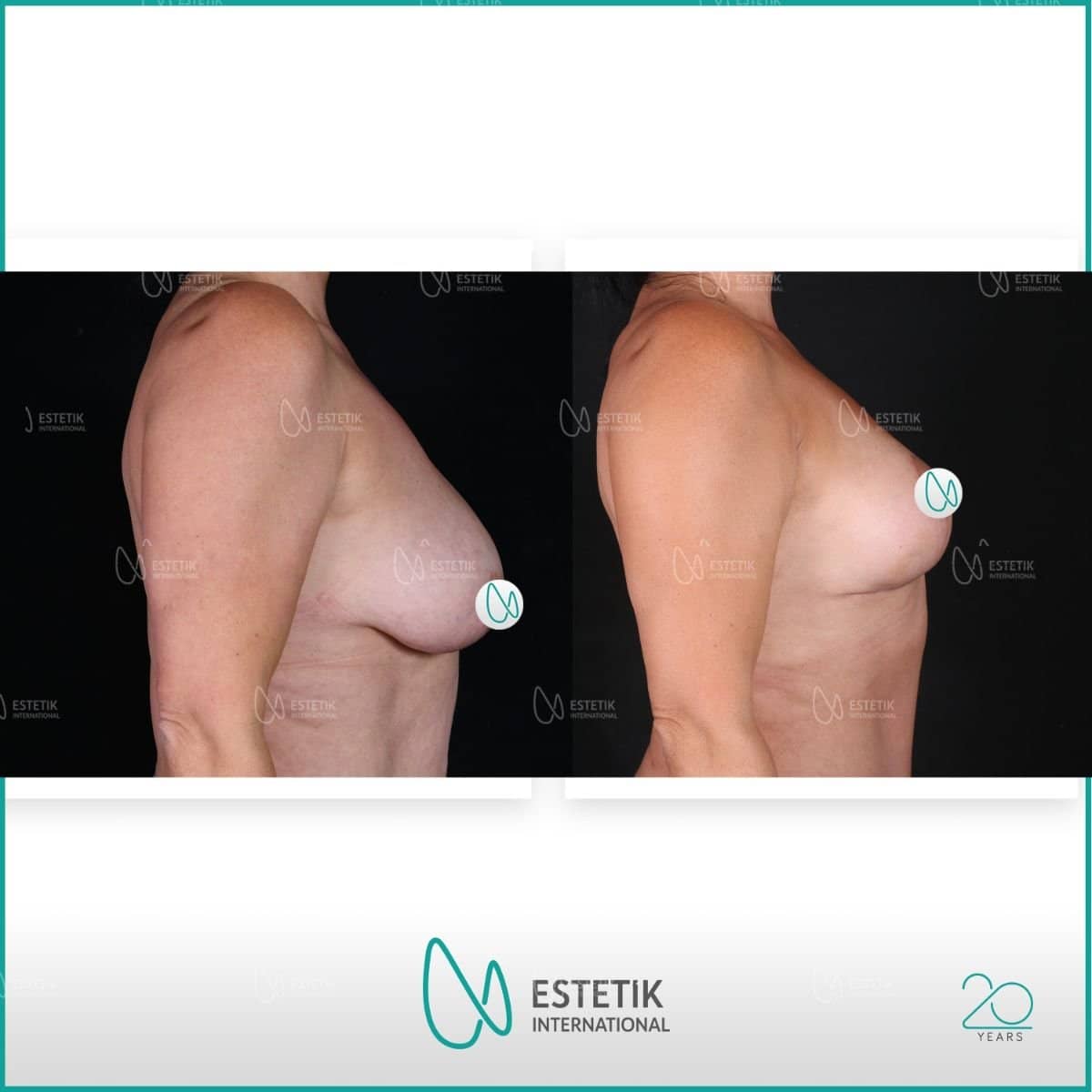 Case 14466 - breast implants with lift