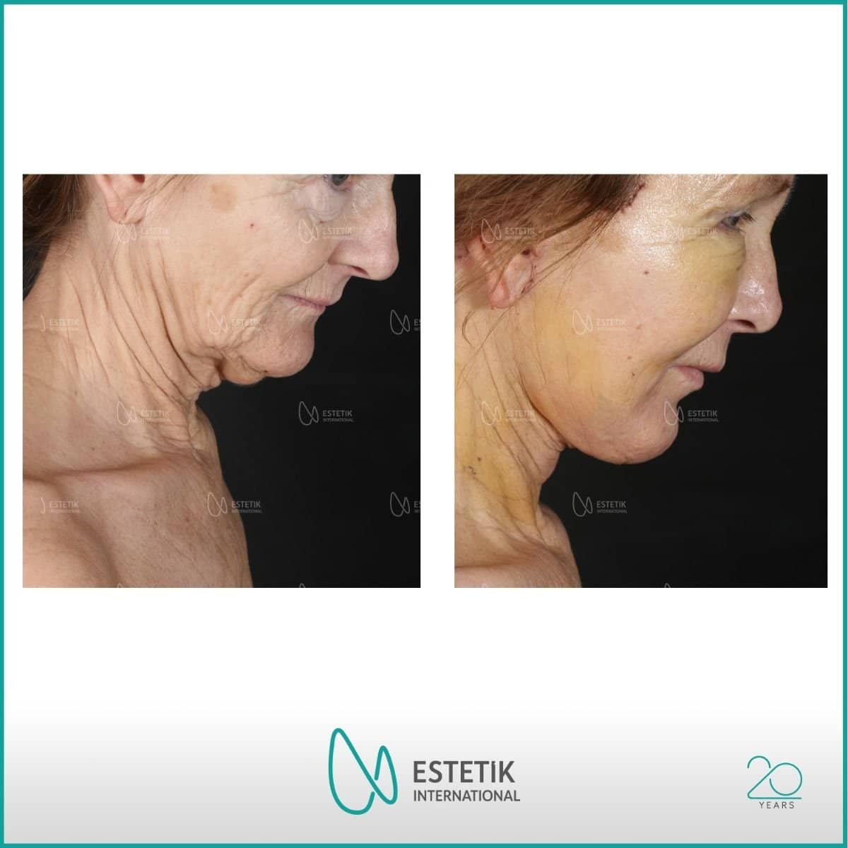 Case 14468 - deep plane facelift