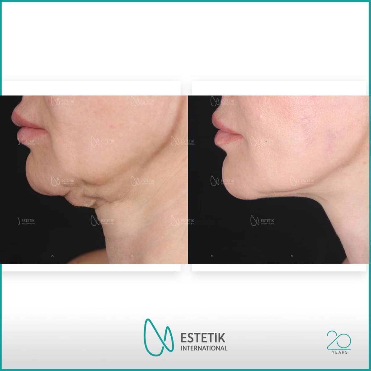 Case 14473 - neck lift