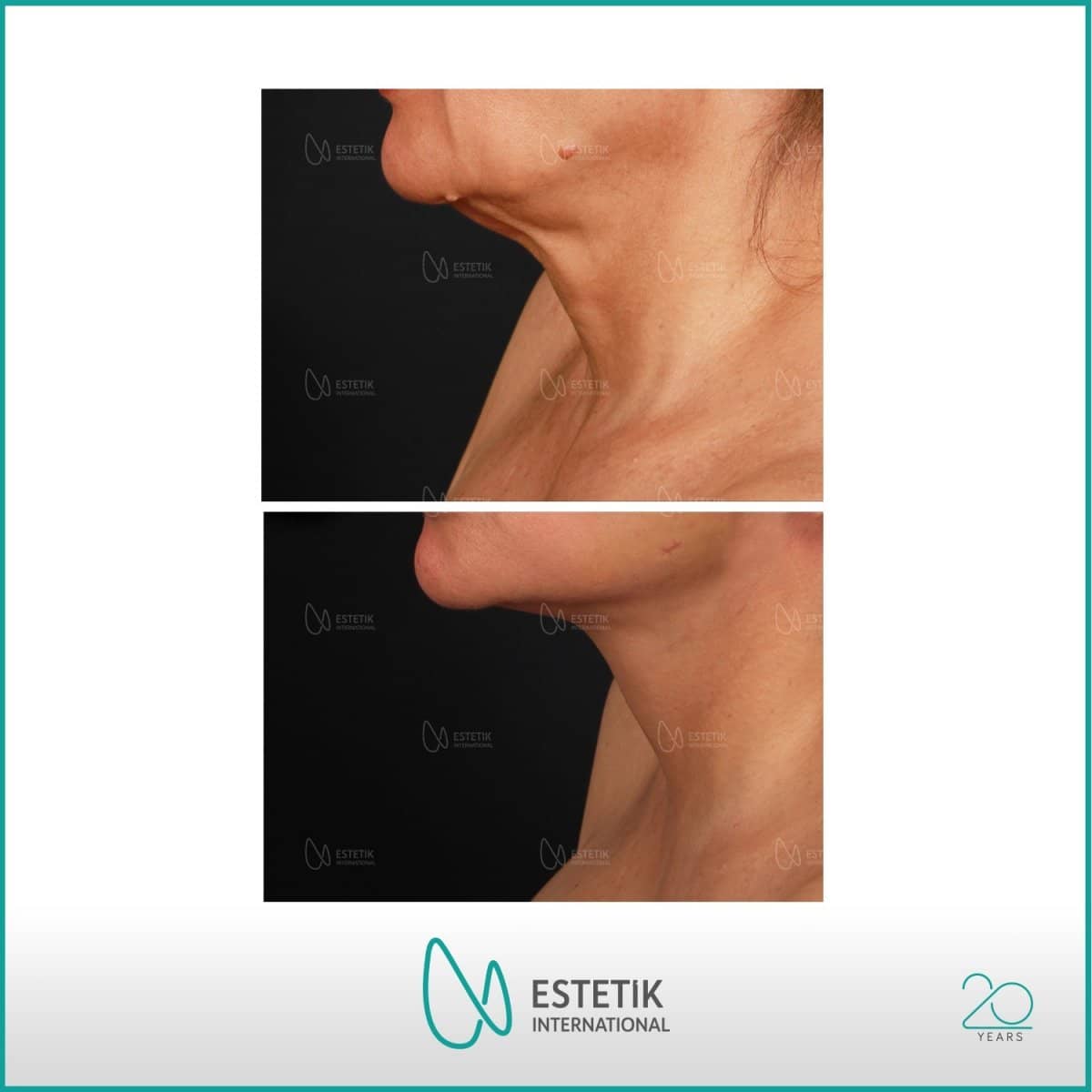 Case 14474 - neck lift