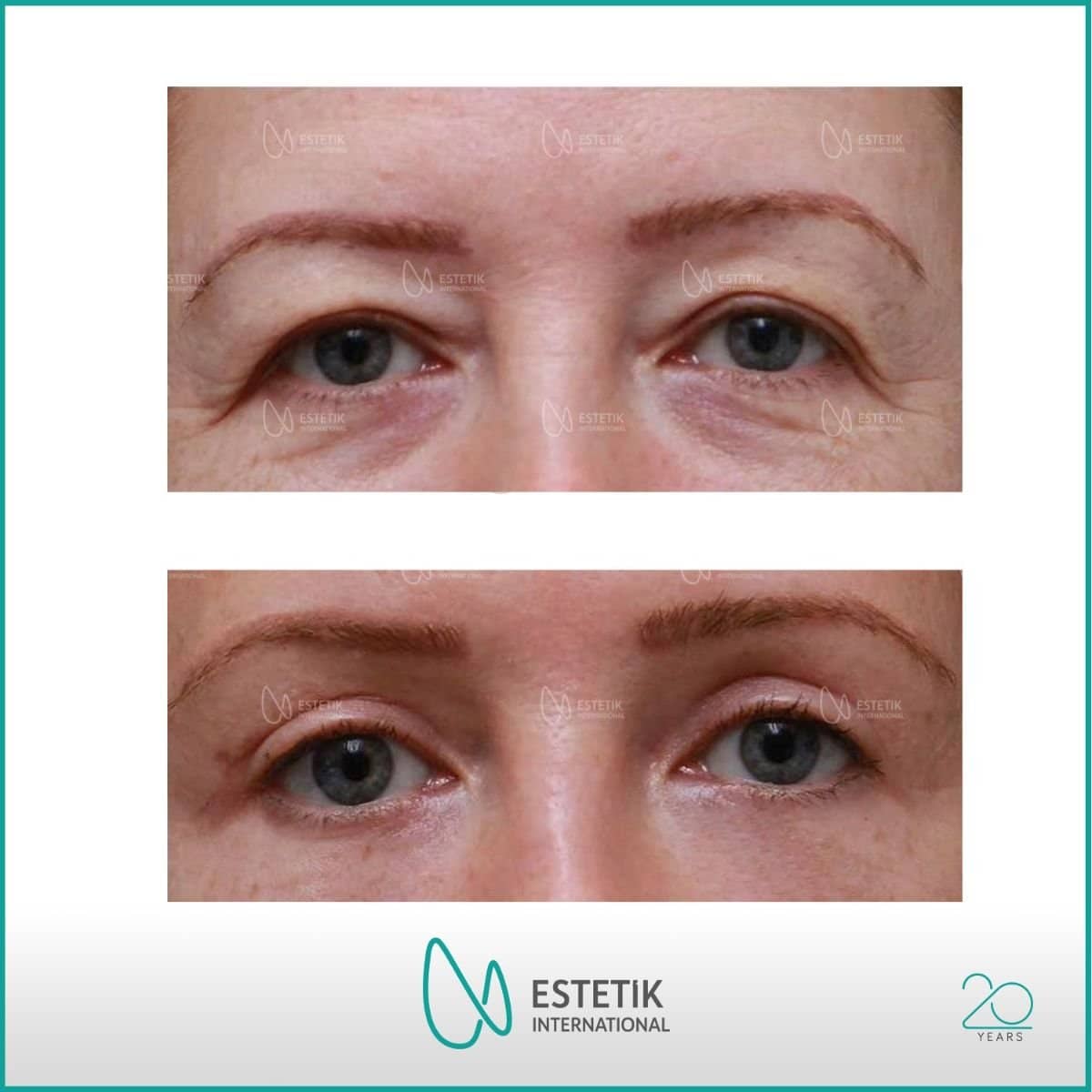 Case 14475 - blepharoplasty