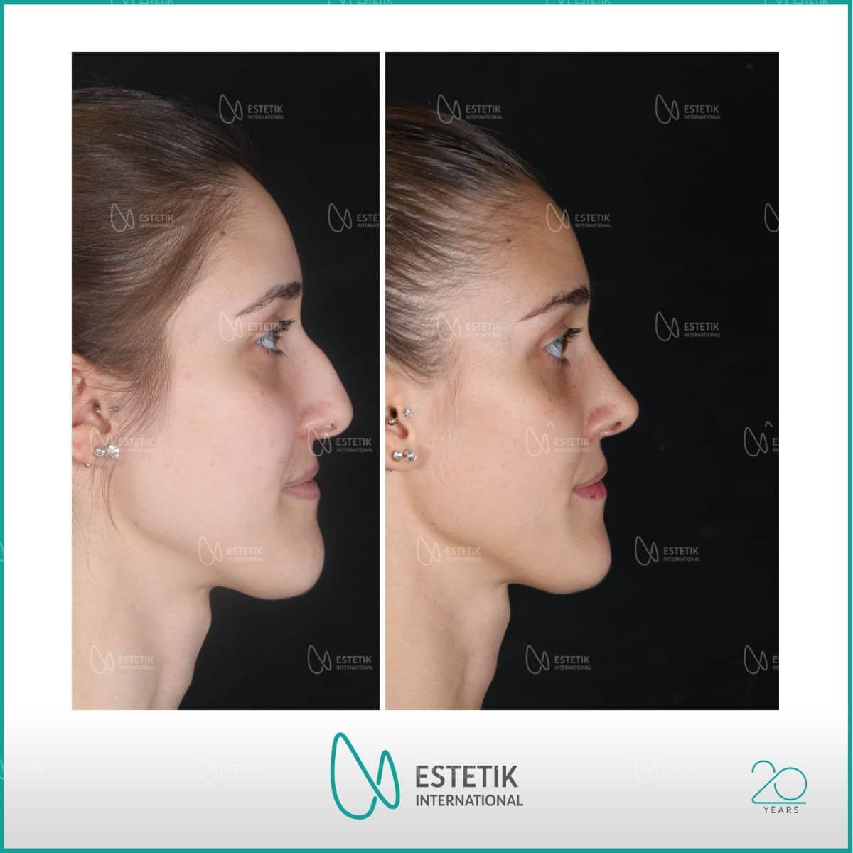 Case 14476 - rhinoplasty