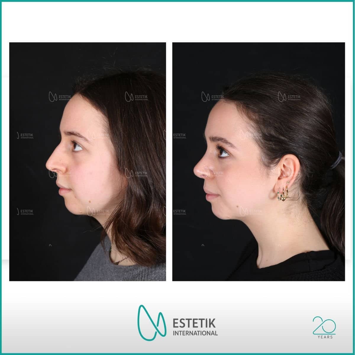 Case 14478 - rhinoplasty